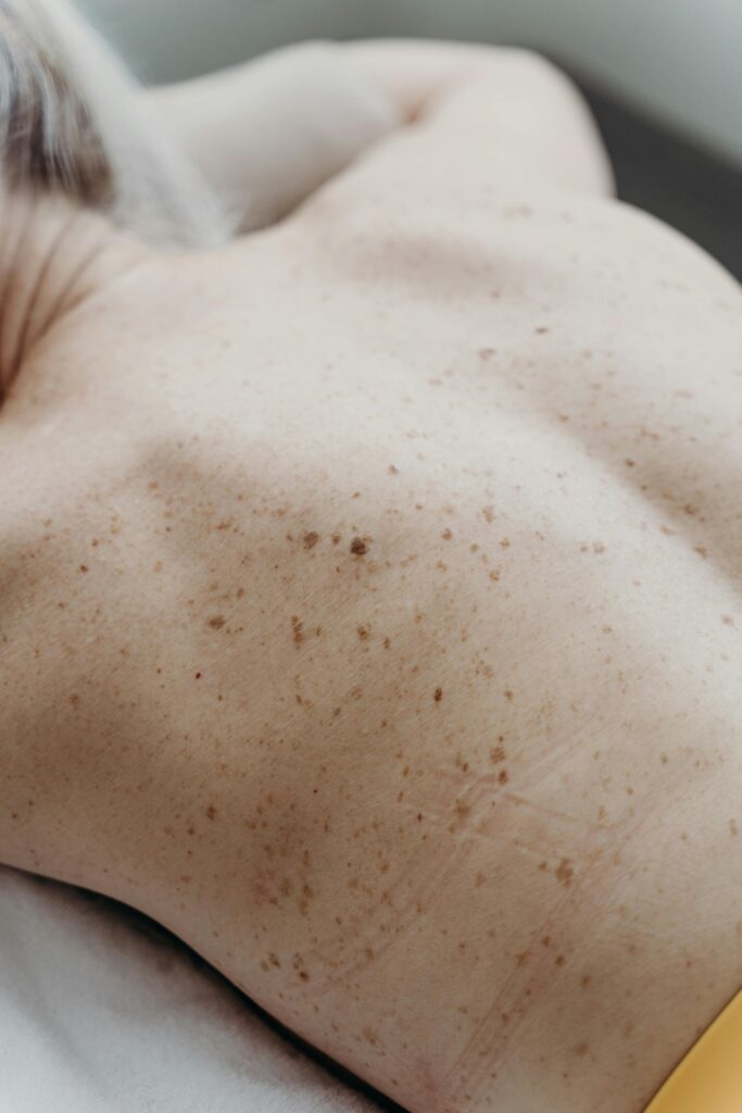 Efelidi post-ustione solare