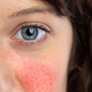 Rossore del viso e del collo