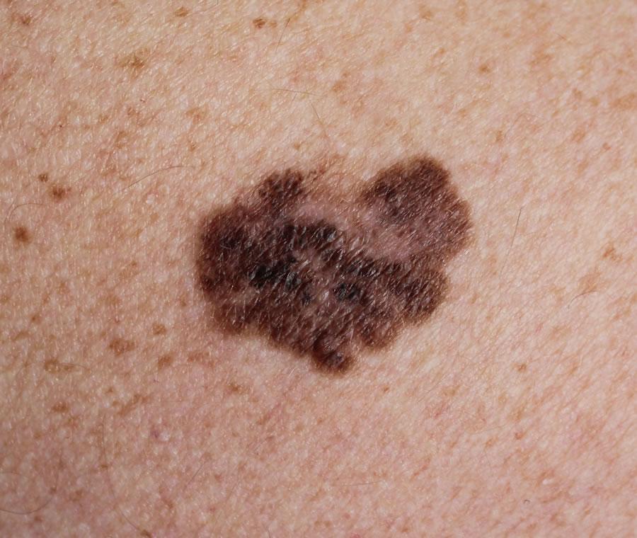 melanoma