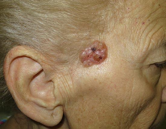 epitelioma basocellulare