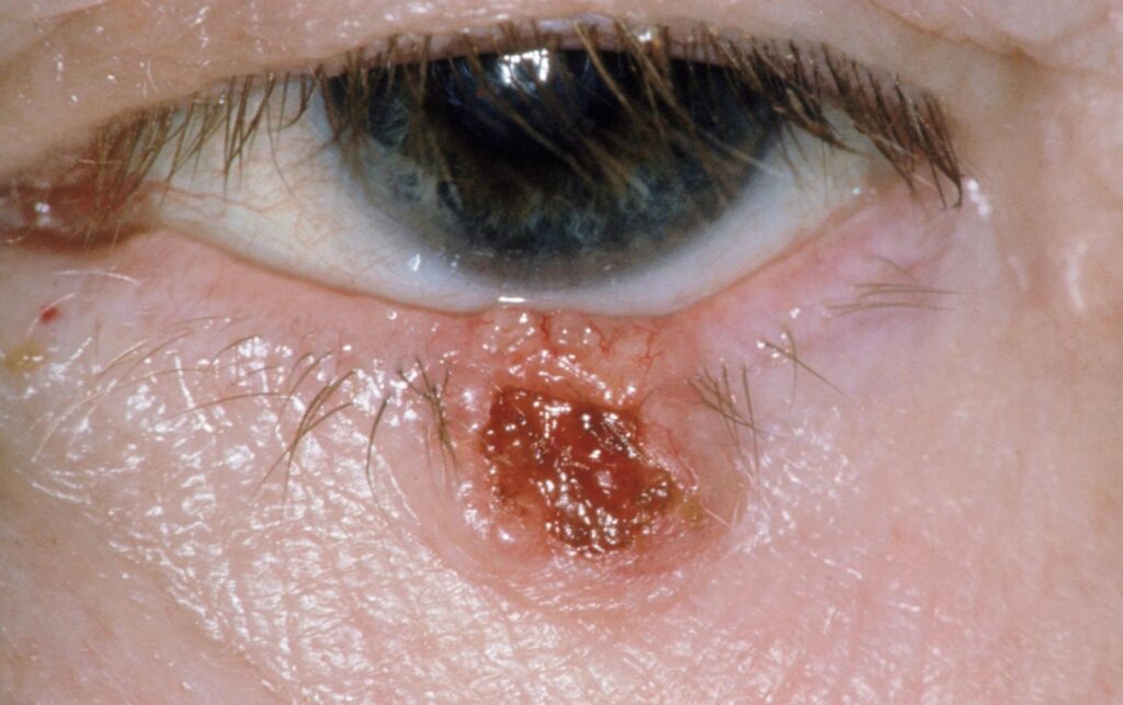 epitelioma basocellulare
