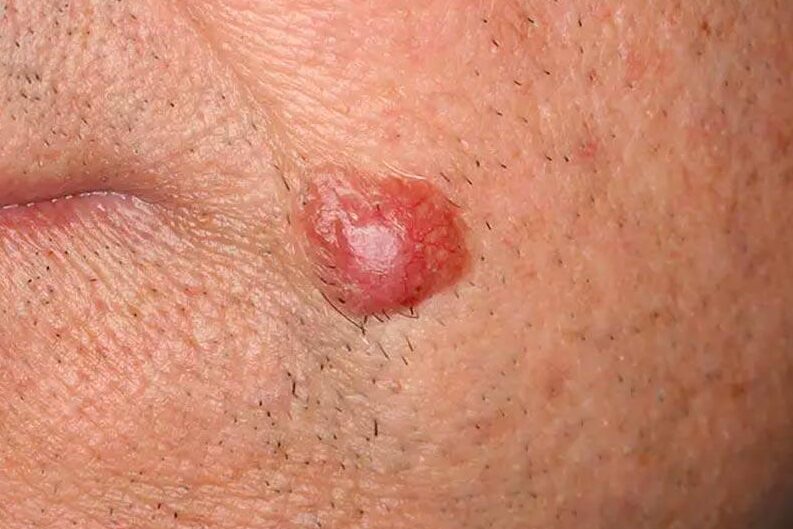 epitelioma basocellulare