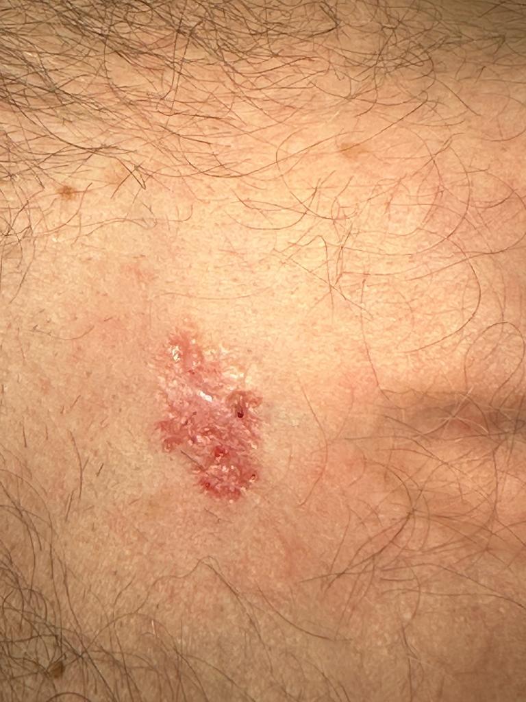 carcinoma basosquamoso